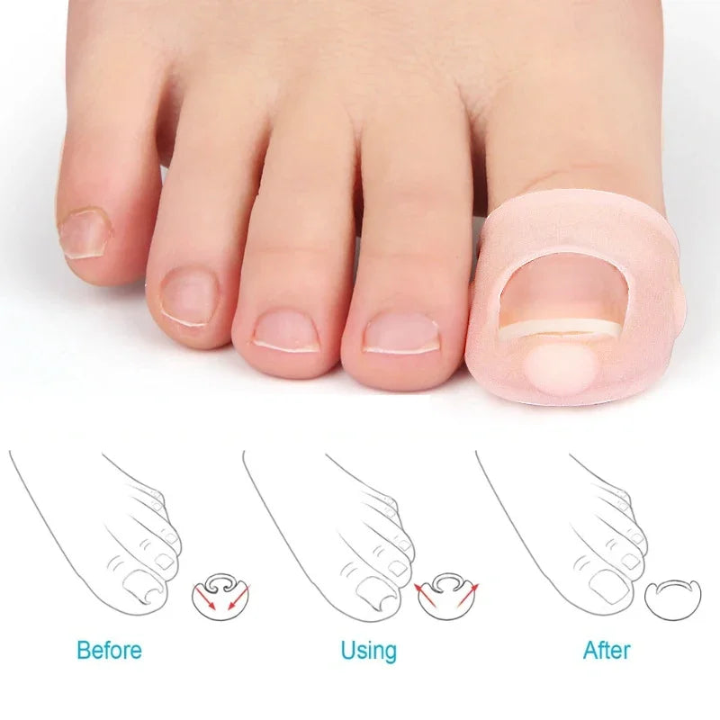 ClearLift Nail Corrector