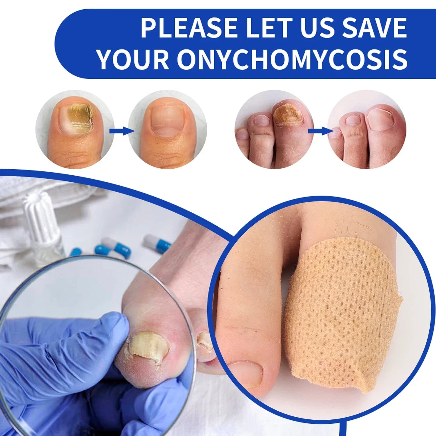 Fungal nail Patches